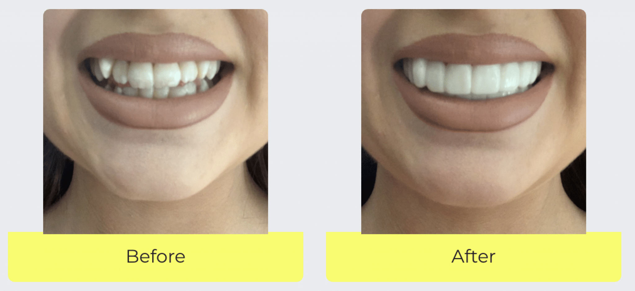 Instasmile The Complete Review Product Review Hero